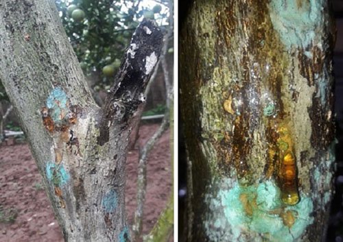 trieu-chung-benh-nut-than-xi-mu